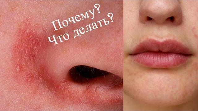 Шелушение кожи ЛОКАЛЬНО. Мнение Дерматолога Шелушение кожи ЛОКАЛЬНО. Мнение Дерматолога