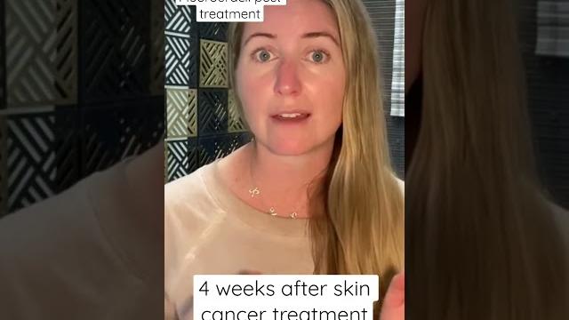 4 weeks post-treatment for skin cancer 4 weeks post-treatment for skin cancer
