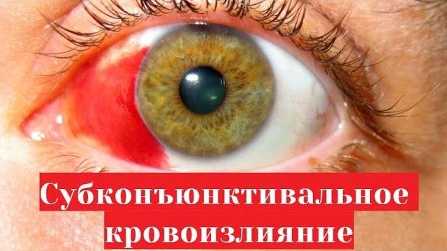 Субконъюнктивальное кровоизлияние (красное пятно на белке) - когда лопнул сосуд на глазу Субконъюнктивальное кровоизлияние (красное пятно на белке) - когда лопнул сосуд на глазу