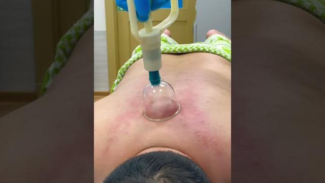 Hijama.pro__ хиджама на спине +7-925-571-07-77 Hijama.pro__ хиджама на спине +7-925-571-07-77