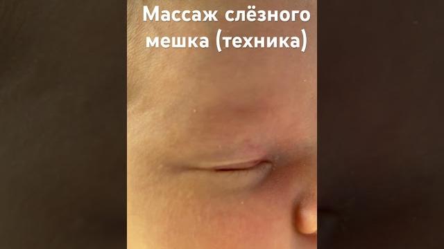 Массаж слёзного мешка. Как делать новорождённому. Массаж слёзного мешка. Как делать новорождённому.