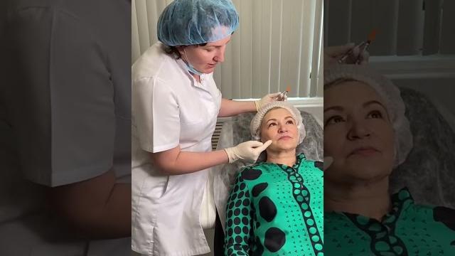 Аугментациях губ и коррекция кисетных морщин Аугментациях губ и коррекция кисетных морщин