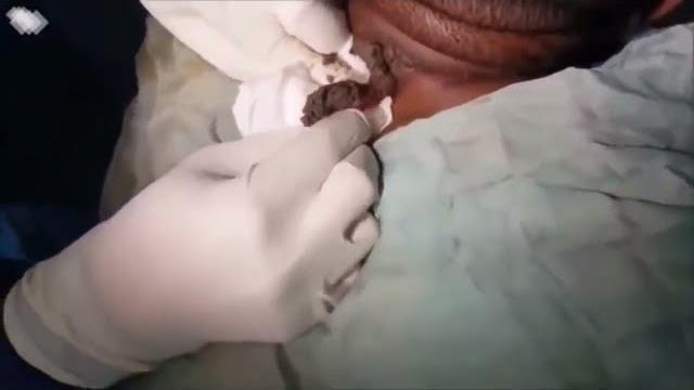 НОВОЕ ВИДЕО 2022 Прыщи давить залипательные НОВОЕ ВИДЕО 2022 Прыщи давить залипательные