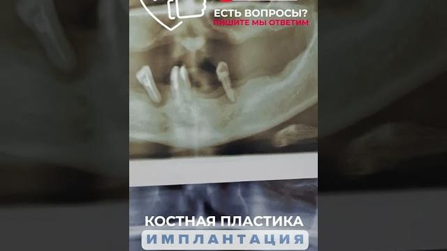 Костная пластика и имплантация. Костная пластика и имплантация.