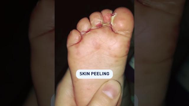 After Hand, Foot & Mouth Disease... #advice #baby #parentalcare #child #handfootmouthdisease After Hand, Foot & Mouth Disease... #advice #baby #parentalcare #child #handfootmouthdisease