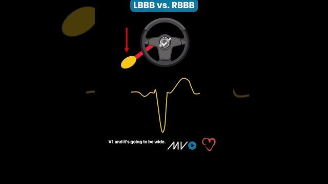 LBBB vs. RBBB Made Easy! 🫀 LBBB vs. RBBB Made Easy! 🫀