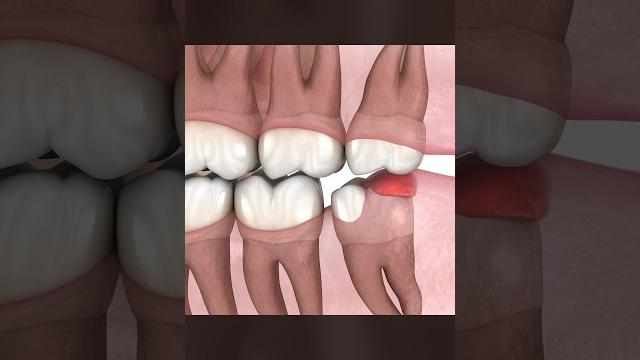Should You Remove Wisdom Teeth? Should You Remove Wisdom Teeth?
