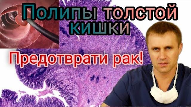Полипы толстой кишки Полипы толстой кишки