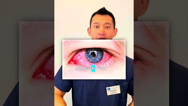 Конъюнктивит может вызвать слепоту #конъюнктивит #контактныелинзы #интересныефакты #ренатказакбаев Конъюнктивит может вызвать слепоту #конъюнктивит #контактныелинзы #интересныефакты #ренатказакбаев