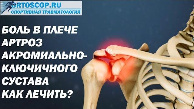 АРТРОЗ АКРОМИАЛЬНО-КЛЮЧИЧНОГО СУСТАВА АРТРОЗ АКРОМИАЛЬНО-КЛЮЧИЧНОГО СУСТАВА
