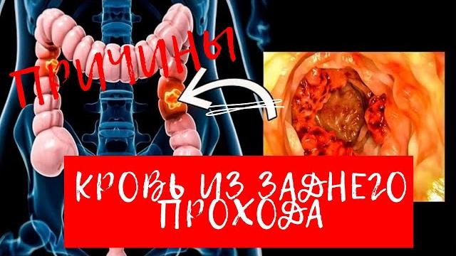 КРОВЬ ИЗ ЗАДНЕГО ПРОХОДА / Причины. КРОВЬ ИЗ ЗАДНЕГО ПРОХОДА / Причины.