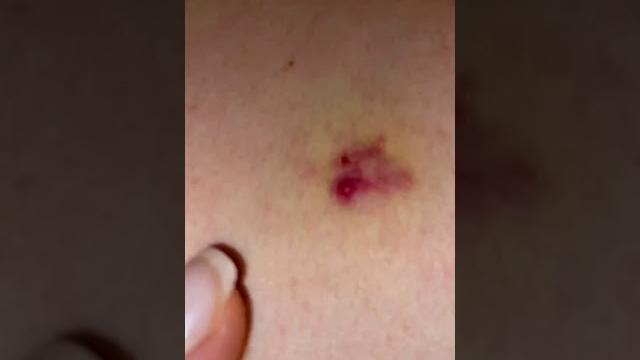 Дину Саеву избили кто избил?? Шок Дину Саеву избили кто избил?? Шок