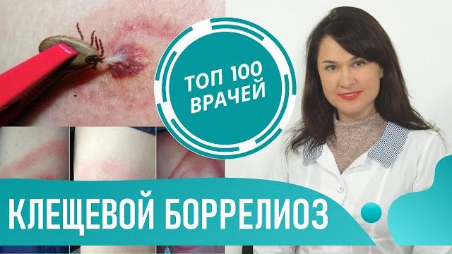 Болезнь Лайма: симптомы, лечение антибиотиками. Клещевой боррелиоз, Лайм-боррелиоз после укуса клеща Болезнь Лайма: симптомы, лечение антибиотиками. Клещевой боррелиоз, Лайм-боррелиоз после укуса клеща