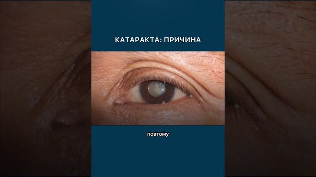Главная причина катаракты. Главная причина катаракты.
