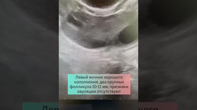 Почему случаются задержки менструации Почему случаются задержки менструации