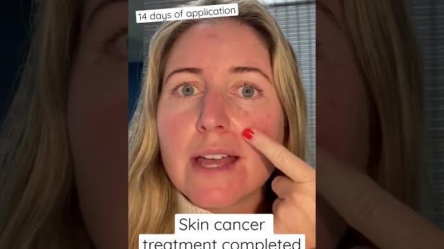 Skin cancer treatment completed! Skin cancer treatment completed!