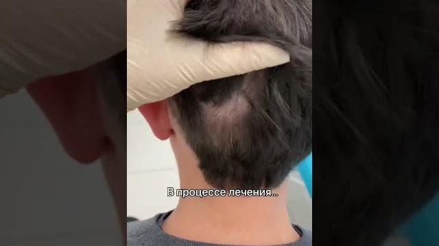 Очаговая алопеция Очаговая алопеция