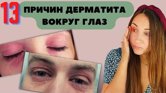 Почему Чешутся Глаза? Дерматит на Веках и Глазах / Аллергия вокруг глаз Причины, Фото, Лечение Почему Чешутся Глаза? Дерматит на Веках и Глазах / Аллергия вокруг глаз Причины, Фото, Лечение