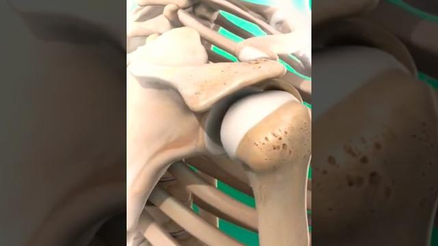 БЛОКАДА - ЛЕЧЕНИЕ БОЛИ В ПЛЕЧЕ Subacromial Injection #блокада #плечи #лечение #плечо #артроз #укол БЛОКАДА - ЛЕЧЕНИЕ БОЛИ В ПЛЕЧЕ Subacromial Injection #блокада #плечи #лечение #плечо #артроз #укол