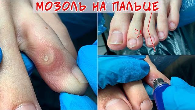 Removal of corns on the leg Removal of corns on the leg