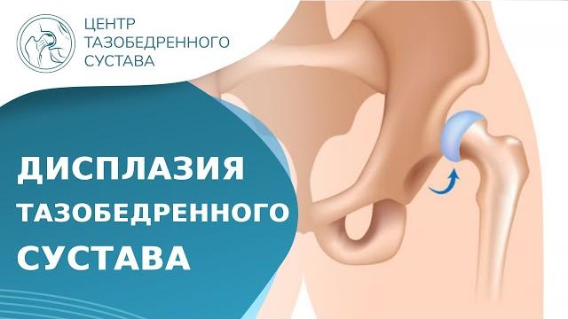 Что такое дисплазия тазобедренного сустава? Дисплазия тазобедренного сустава что это. 18+ Что такое дисплазия тазобедренного сустава? Дисплазия тазобедренного сустава что это. 18+