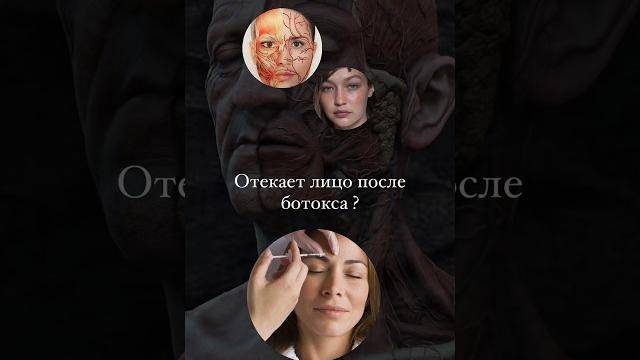Почему отекает лицо после ботокса ? Отеки Почему отекает лицо после ботокса ? Отеки