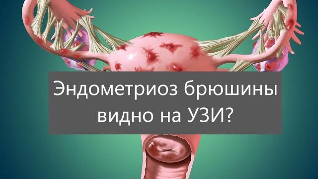 Эндометриоз брюшины видно на УЗИ? Эндометриоз брюшины видно на УЗИ?