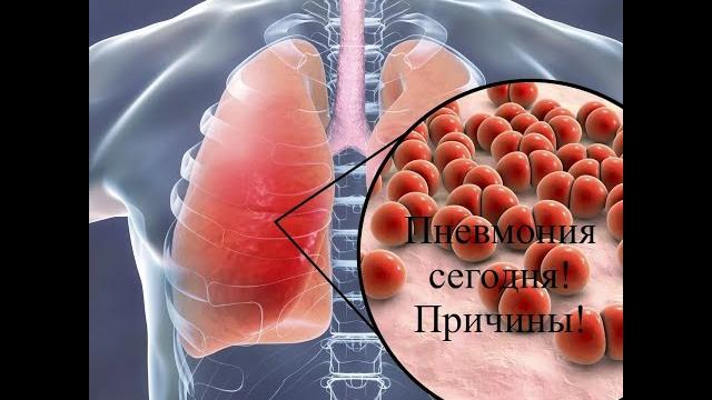 Внебольничная пневмония Внебольничная пневмония