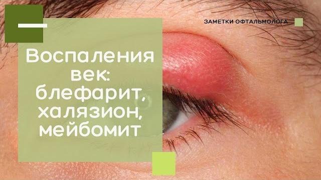 Воспаление век: блефариты, халязионы, мейбомиты Воспаление век: блефариты, халязионы, мейбомиты