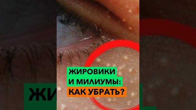 Как избавиться от жировиков? Как избавиться от жировиков?