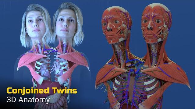Two Heads, One Body: Anatomy of Conjoined Twins Two Heads, One Body: Anatomy of Conjoined Twins