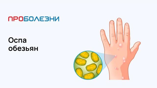 Оспа обезьян Оспа обезьян