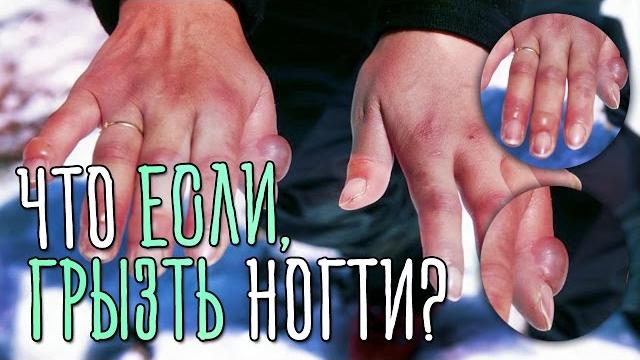 ЧТО БУДЕТ, ЕСЛИ ГРЫЗТЬ НОГТИ! ЧТО БУДЕТ, ЕСЛИ ГРЫЗТЬ НОГТИ!
