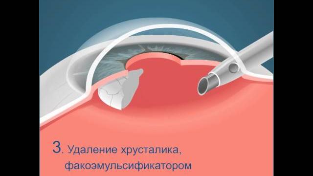 Операция по удалению катаракты — факоэмульсификация Операция по удалению катаракты — факоэмульсификация