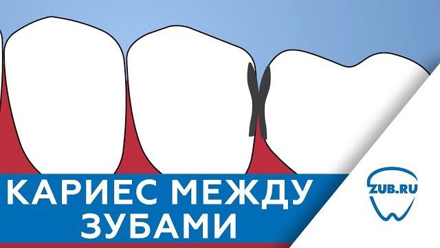 Кариес между зубами Кариес между зубами