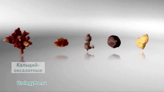 Камни почек. Что нужно знать и как правильно лечить Камни почек. Что нужно знать и как правильно лечить