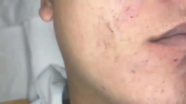 прыщи давить новое видео залипательные прыщи давить новое видео залипательные
