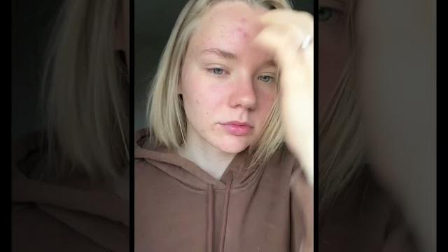 Чудо способ против подкожных прыщей #уходзакожей Чудо способ против подкожных прыщей #уходзакожей