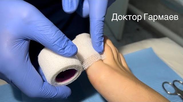 Перевязка после операции удаления вросшего ногтя Перевязка после операции удаления вросшего ногтя
