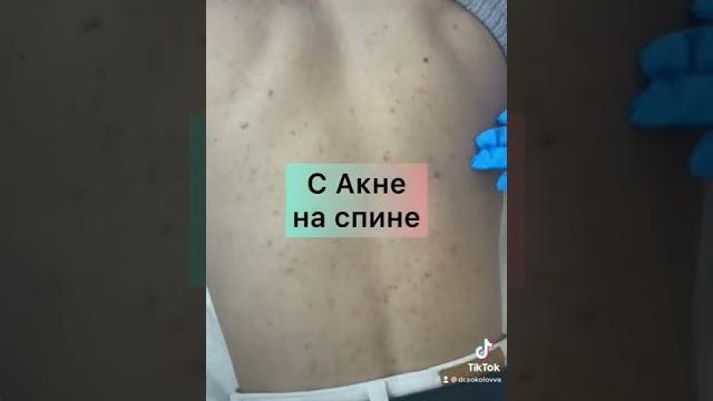 как лечить акне на спине как лечить акне на спине