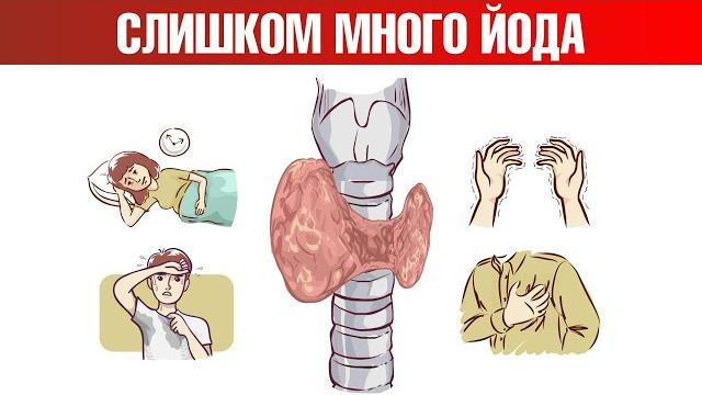 Признак №1 избытка йода в организме Признак №1 избытка йода в организме