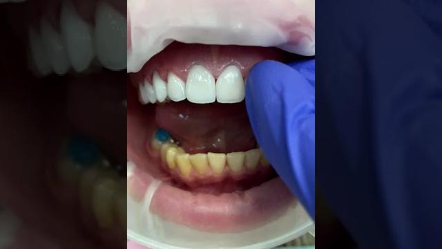 Установка виниров E-max. #emaxveneers #виниры Установка виниров E-max. #emaxveneers #виниры