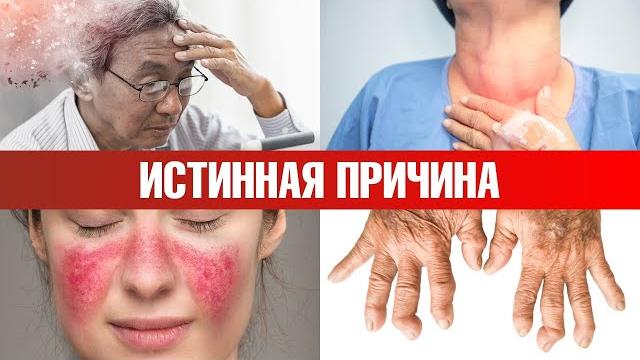 Основная причина всех аутоиммунных заболеваний Основная причина всех аутоиммунных заболеваний